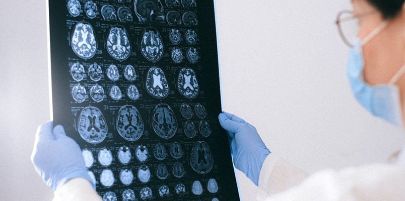 analiza LORETA EEG pokazująca wpływ neuroplastra Liberty Super Patch przy chorobie Parkinsona